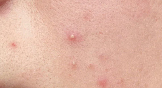 近年來祛痘類功效護膚品發(fā)展如何？